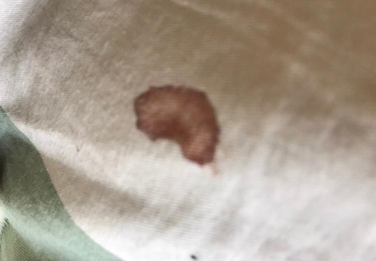 请问这个血迹是怎么引起的呢? 请问这个血迹是怎么引起的呢?