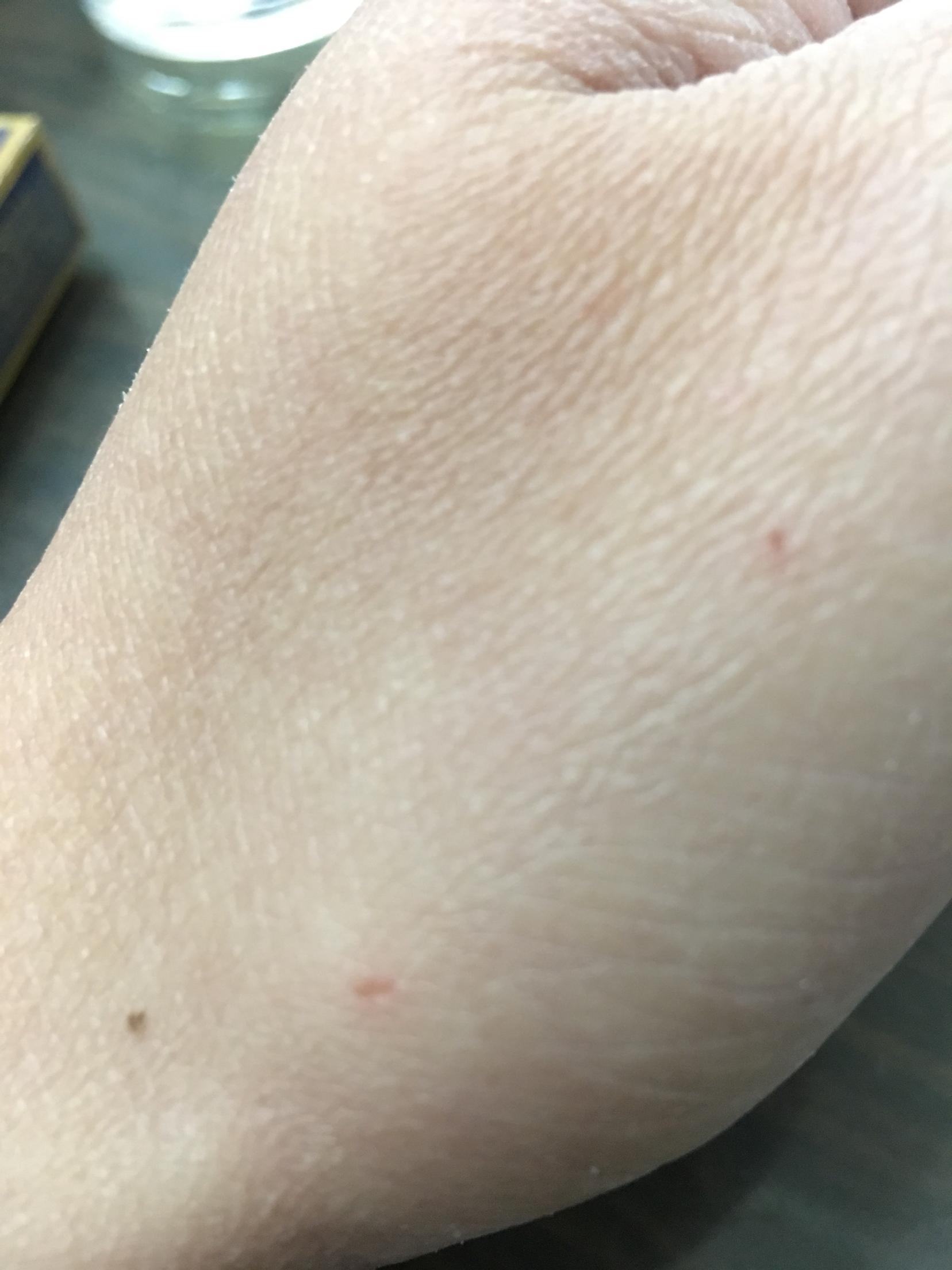 被自家狗狗咬伤一点