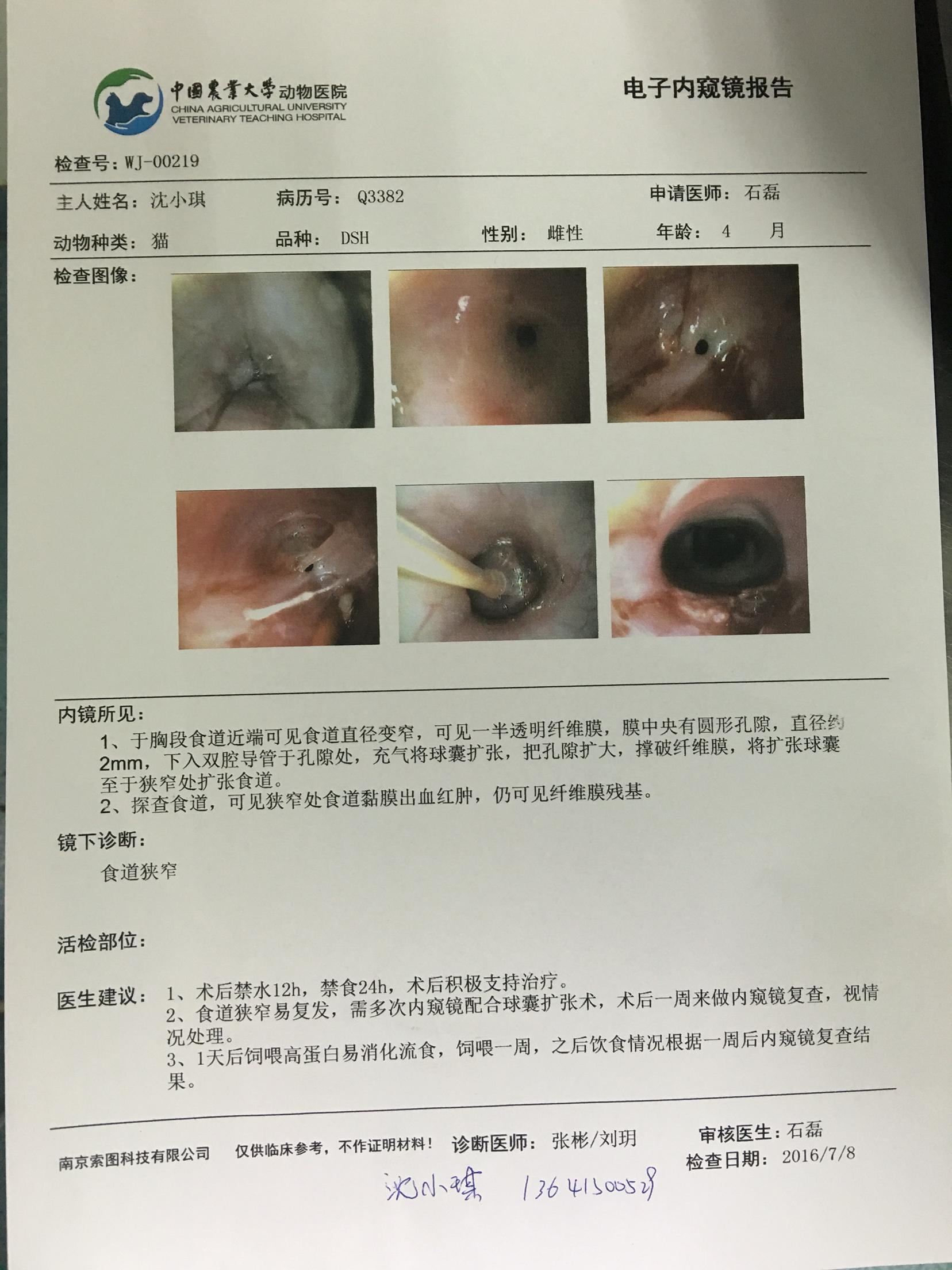 食道狭窄