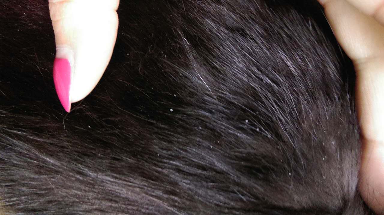 有无臀部没现的粟丘疹的简双先容 -唯诗兰去脂肪粒