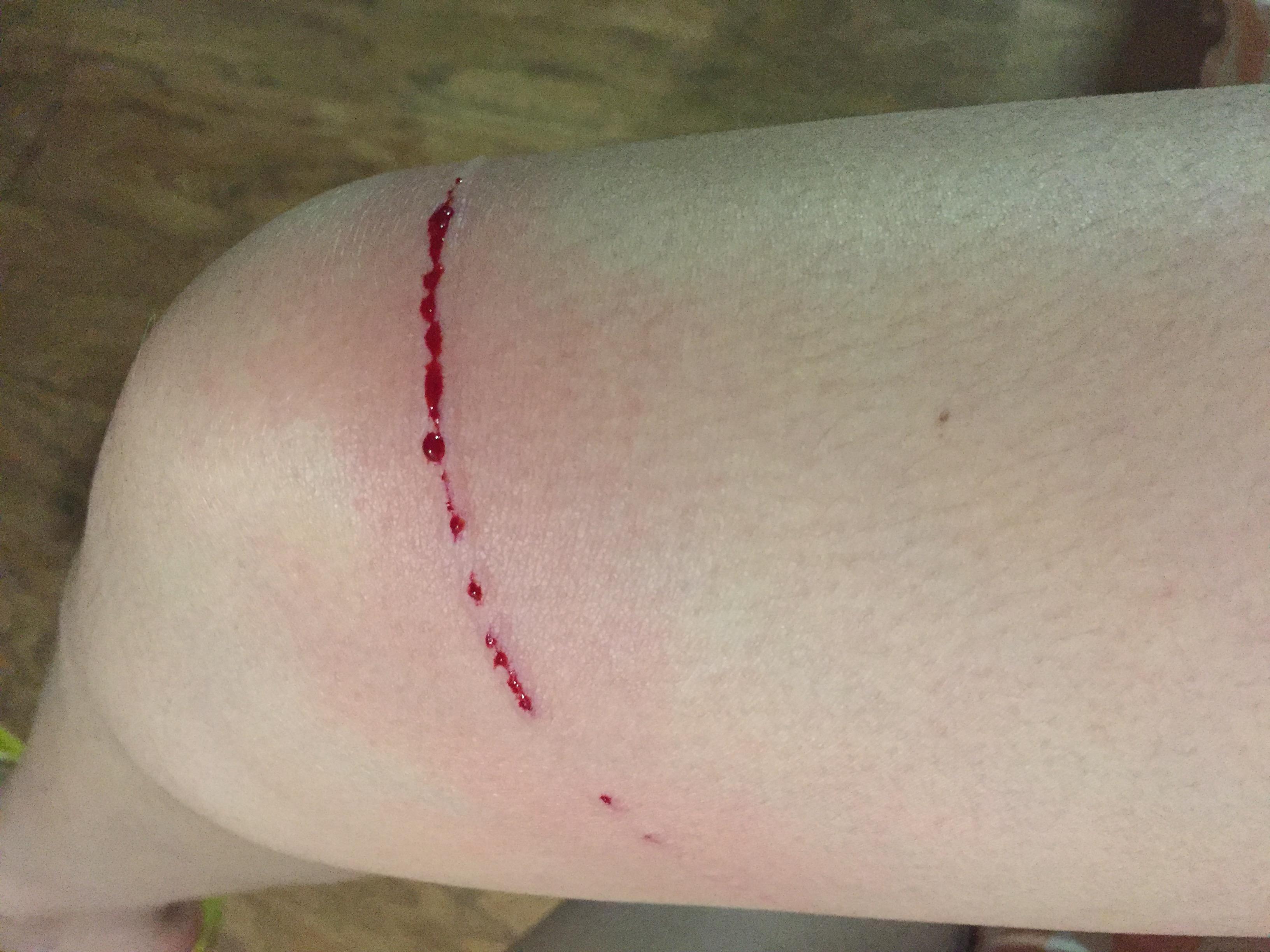 请问昨天晚上被自家的英短抓了一条比较大的伤口,猫咪半年内打过